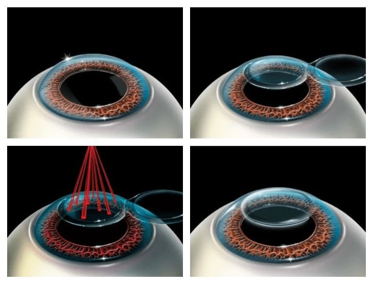 После коррекции зрения мутно видела. Lasik лазерный кератомилез. лазерная коррекция зрения методом фрк. капли после лазерной коррекции зрения ласик.